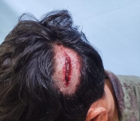 संपत्ति विवाद में देवर ने भाभी का सिर थोड़ा फोड़ा भतीजे को लगे 18 टांके