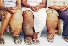 फाइलेरिया उन्मूलन: UPSRLM और बेसिक शिक्षा विभाग भी आए साथ फाइलेरिया