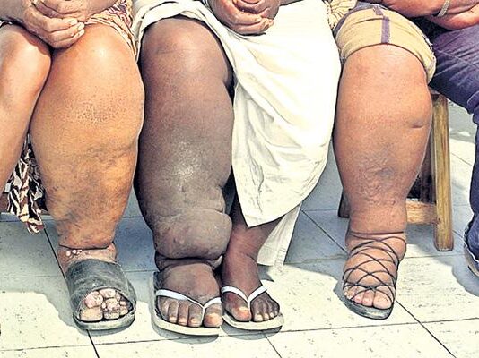 फाइलेरिया एक लाइलाज बीमारी… फाइलेरिया एक लाइलाज बीमारी...