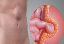 हर्निया का घरेलू उपाय हर्निया का घरेलू उपाय