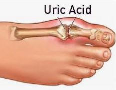अत्यंत दर्दनाक है रक्त में यूरिक एसिड का बढ़ा स्तर