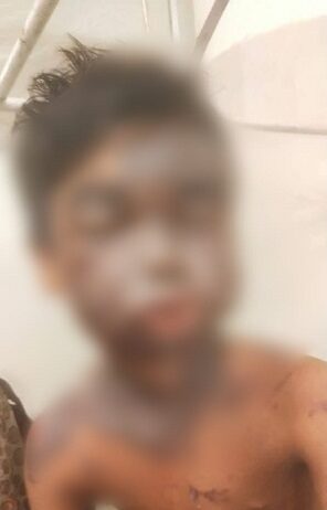 पकौड़ी मांगने पर बच्चे के चेहरे पर फेका खौलता तेल पकौड़ी मांगने पर बच्चे के चेहरे पर फेका खौलता तेल