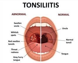 गले में होने वाला कष्टदायक रोग टॉन्सिलाइटिस का उपचार