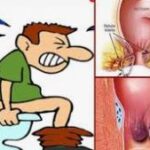 शौच करते समय जलन और दर्द तो हो सकता है भगंदर? शौच करते समय जलन और दर्द तो हो सकता है भगंदर?