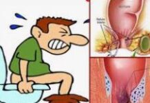 शौच करते समय जलन और दर्द तो हो सकता है भगंदर? शौच करते समय जलन और दर्द तो हो सकता है भगंदर?