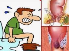 शौच करते समय जलन और दर्द तो हो सकता है भगंदर? शौच करते समय जलन और दर्द तो हो सकता है भगंदर?