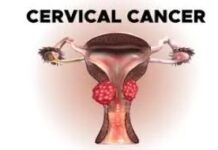 सर्वाइकल कैंसर के खिलाफ टीकाकरण अभियान सर्वाइकल कैंसर के खिलाफ टीकाकरण अभियान