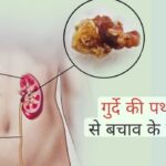 किडनी स्टोन क्यों बनते हैं? जानें बचाव के तरीके