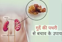 किडनी स्टोन क्यों बनते हैं? जानें बचाव के तरीके