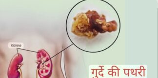 किडनी स्टोन क्यों बनते हैं? जानें बचाव के तरीके