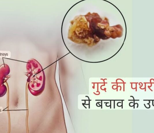 किडनी स्टोन क्यों बनते हैं? जानें बचाव के तरीके
