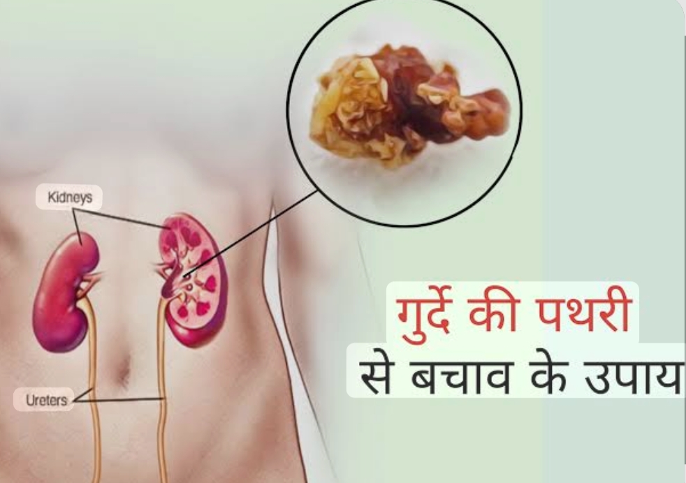 Photo of किडनी स्टोन क्यों बनते हैं? जानें बचाव के तरीके