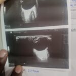 आयुष्मान योजना पर दाग! KGMU में मरीजों के साथ लापरवाही