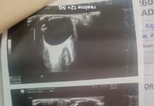 आयुष्मान योजना पर दाग! KGMU में मरीजों के साथ लापरवाही